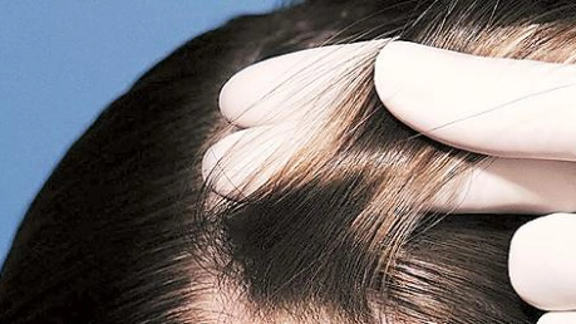 La alopecia traccional puede ser reversible en la mayoría de los casos