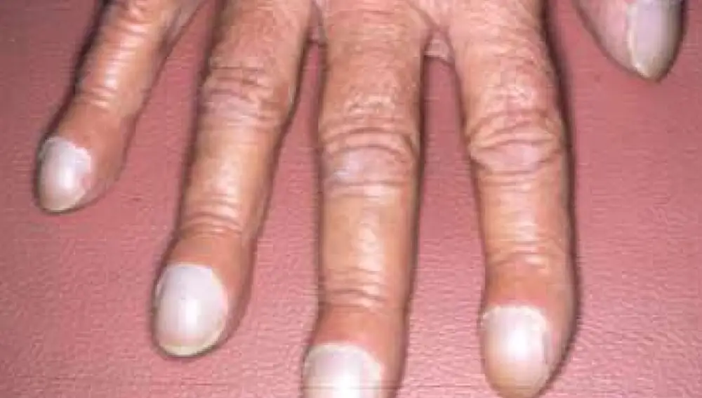 Los dedos de las manos y pies en palillo de tambor se pueden presentar rápidamente, a menudo en cuestión de semanas y en cuanto se trata la causa desaparece