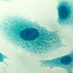 Células de cáncer de próstata