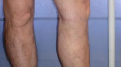 Foto del resultado después de la intervención