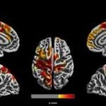 Imágenes cerebrales de niños de 12 años muestran regiones del cerebro en rojo, naranja y amarillo que son las más afectadas por la contaminación del aire relacionada con el tráfico.CINCINNATI CHILDREN'S HOSPITAL M24/01/2020