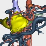 Reconstrucción 3D de un tumor para abordar su resección en una cirugía a paciente oncológicoHM HOSPITALES11/02/2020