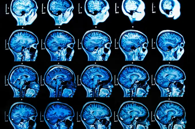 Estado de coma: La ciencia se acerca a recuperar la consciencia del cerebro
