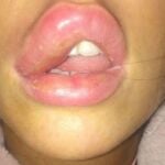 Jessica Myott muestra la inflamación de su labio tras la intervención