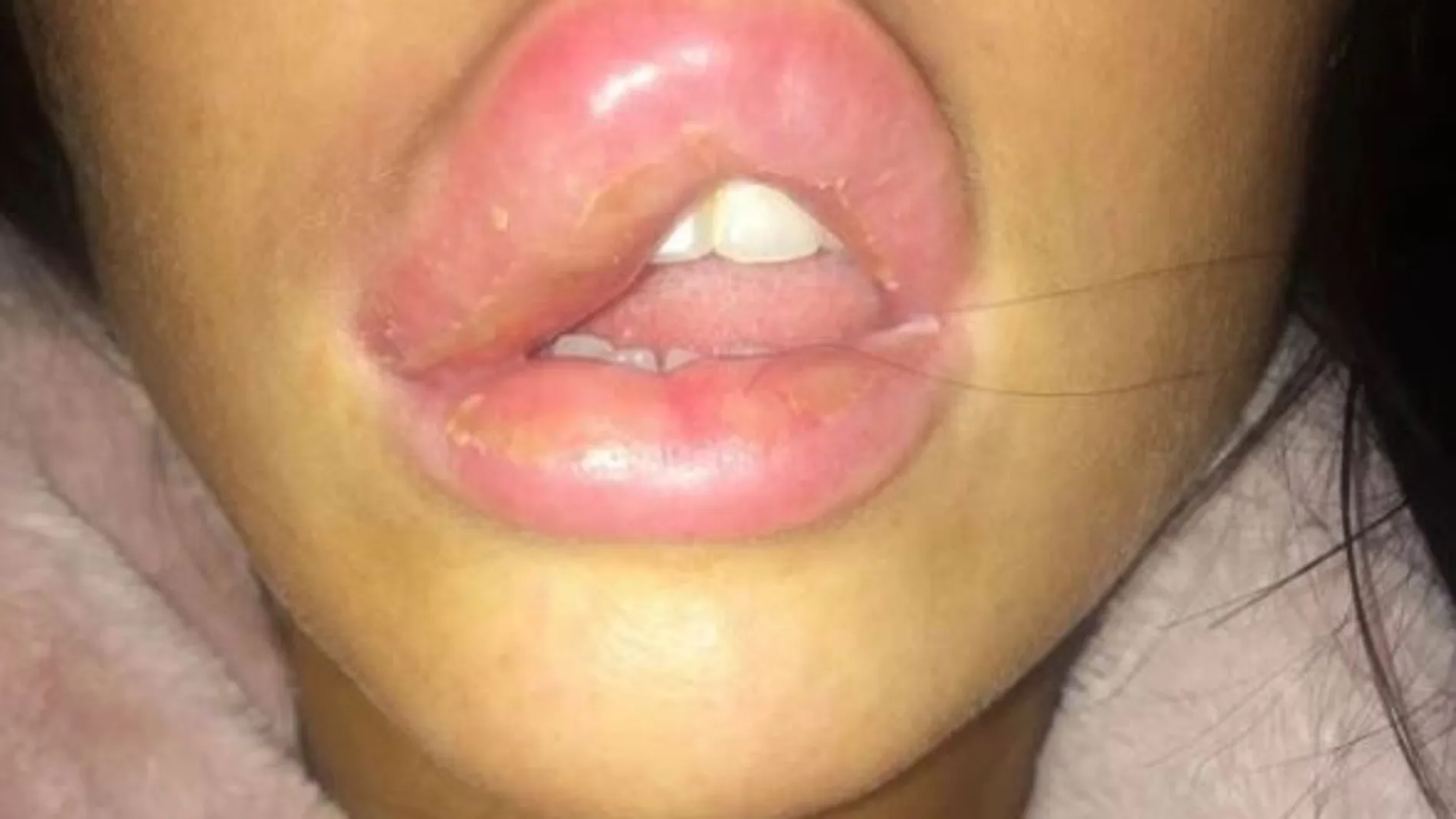 Jessica Myott muestra la inflamación de su labio tras la intervención