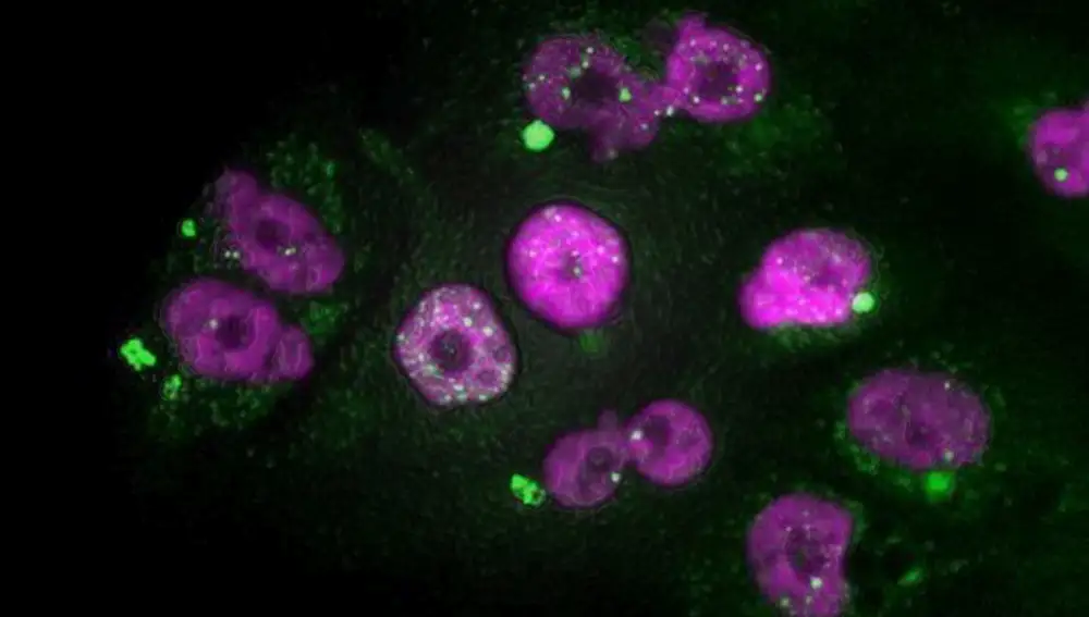 Ejemplo de células tumorales de adenocarcinoma de páncreas