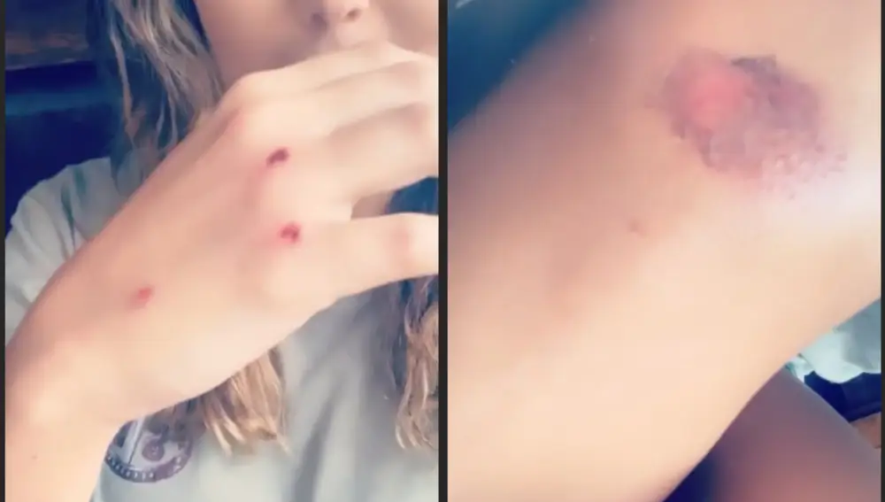 Lara Álvarez muestra sus heridas en Instagram
