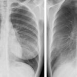 A la izquierda, una prueba de rayos X convencional. A la derecha, una imagen de un plano de tomosíntesis en la que seIdentifica con claridad la patología que no se aprecia en la imagen de la izquierda.GE HEALTHCARE28/04/2020