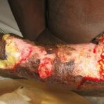 La necrosis muscular es uno de los efectos de la mordedura de las serpientes hemotóxicas
