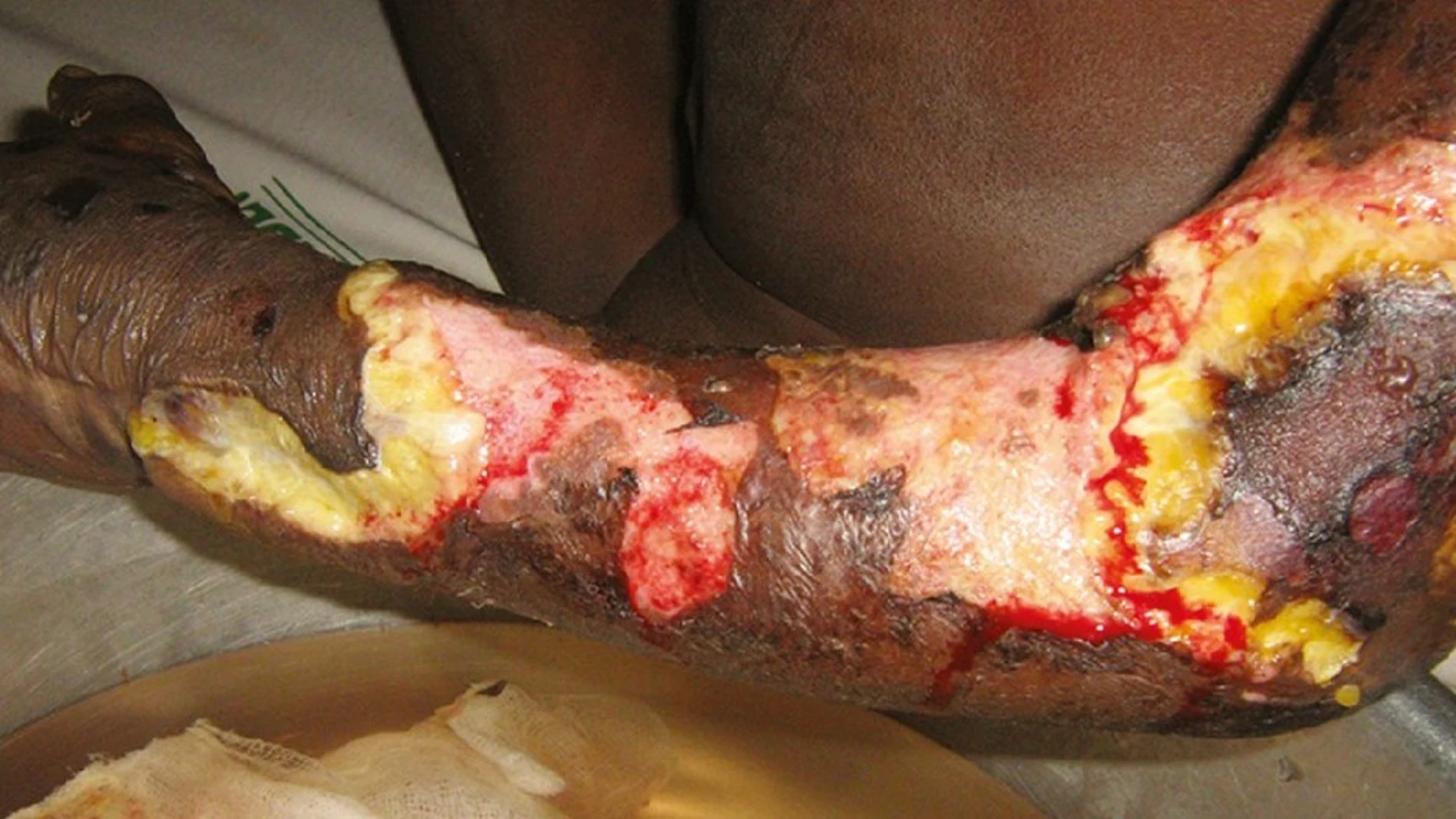 La necrosis muscular es uno de los efectos de la mordedura de las serpientes hemotóxicas