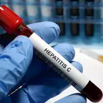  Eliminar la hepatitis C en España es posible