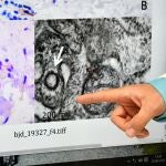 El coronavirus es visible en las biopsias de piel realizadas en lesiones de tipo sabañones en niños