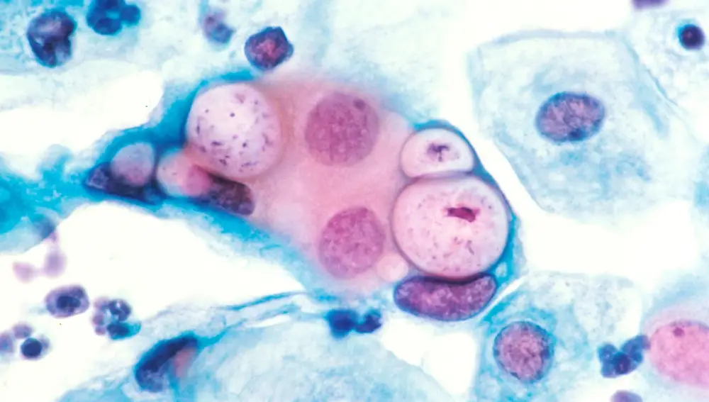 Prueba de Papanicolaou mostrando clamidia en las vacuolas de las células.