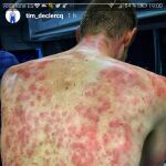 Así quedó la espalda de Tim De Clerq por culpa del granizo