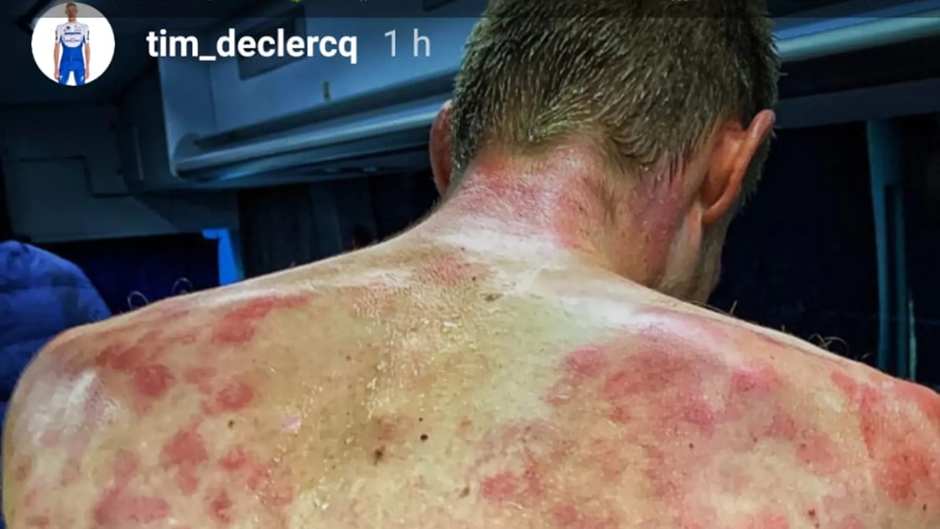 Así quedó la espalda de Tim De Clerq por culpa del granizo