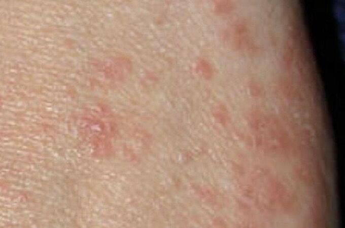 La sarna es una enfermedad contagiosa de la piel causada por un ácaro