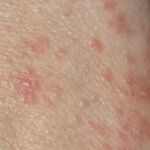 La sarna es una enfermedad contagiosa de la piel causada por un ácaro