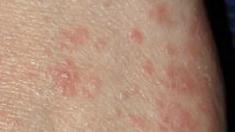 La sarna es una enfermedad contagiosa de la piel causada por un ácaro