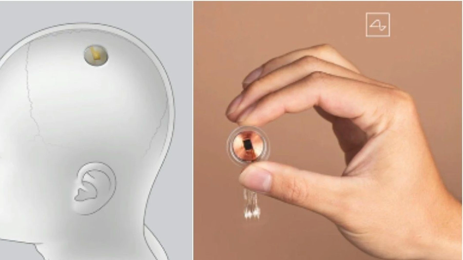 A la izquierda se muestra una ilustración de dónde se implantaría el dispositivo. A la derecha se muestra el dispositivo en sí con una fotografía real.
