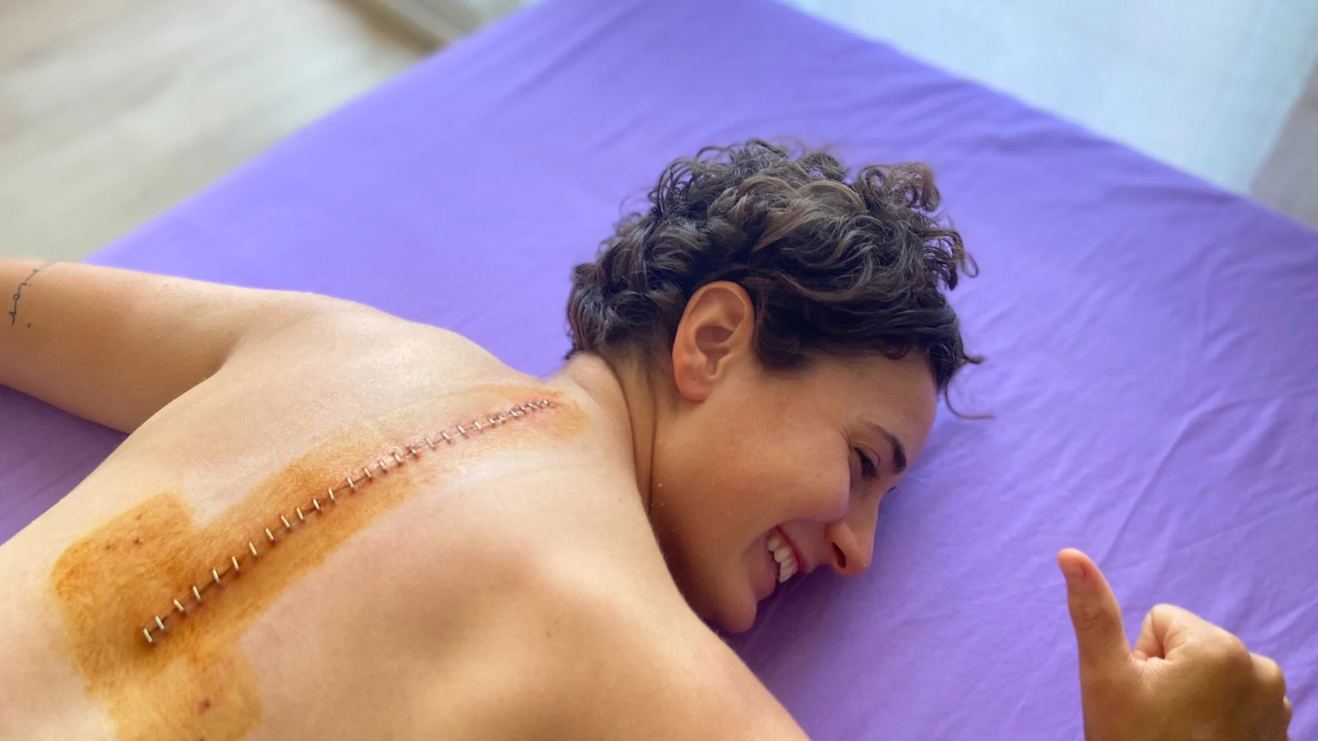 Ana Carrasco mostró en redes sociales la cicatriz que le quedó en la espalda tras ser operada