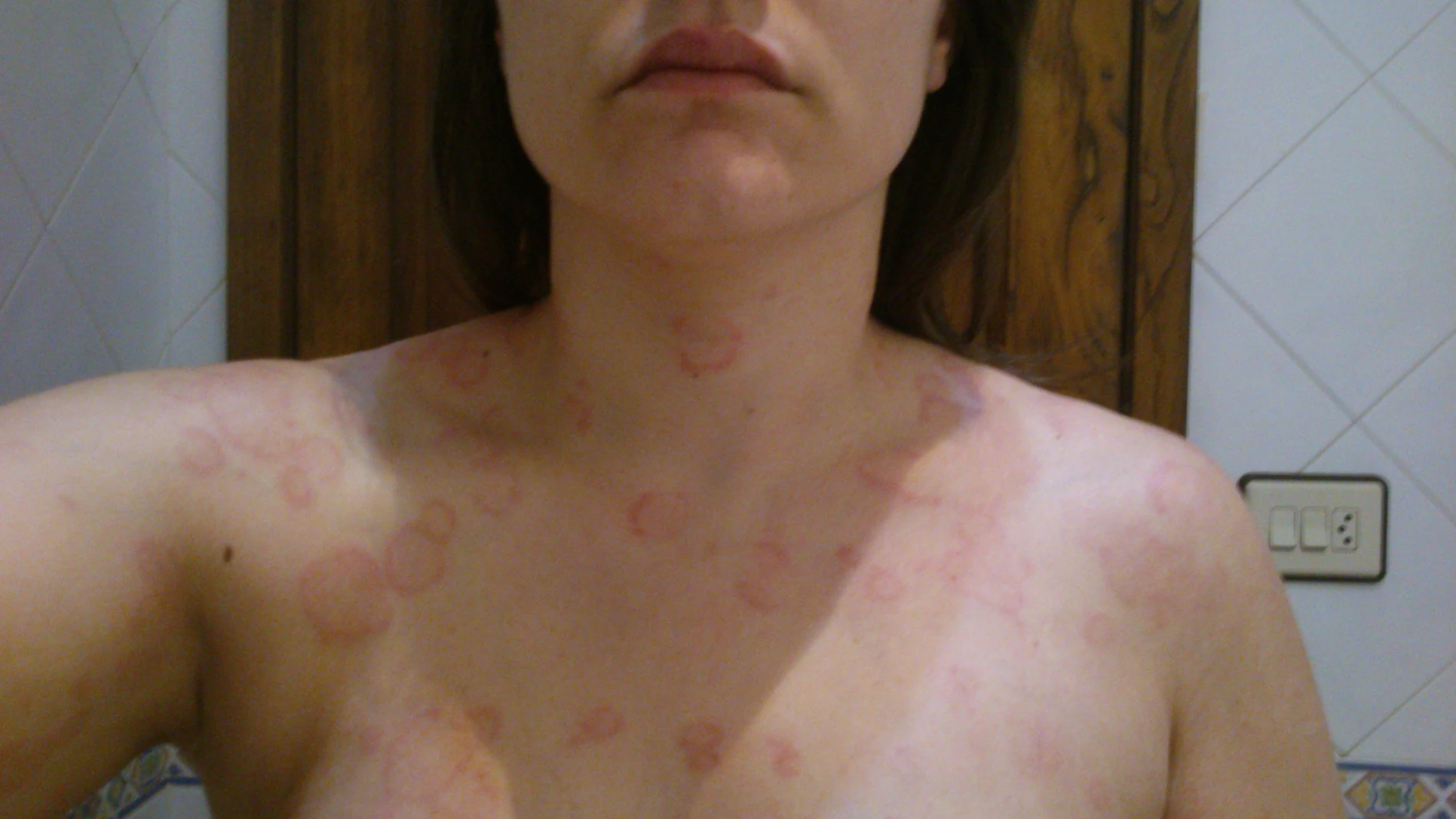 Diana Diéguez, paciente con urticaria crónica, una enfermedad de carácter autoinmune que surge de manera espontánea