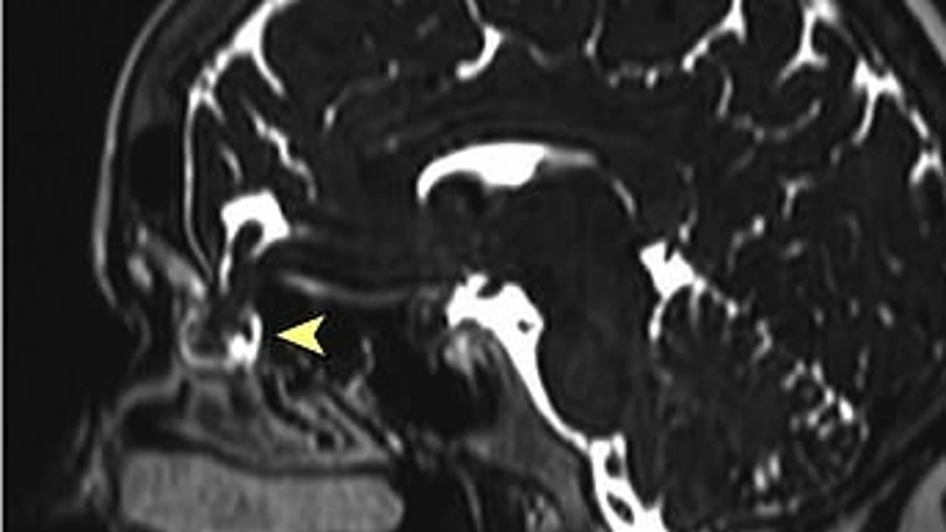 Radiografía de la cabeza de la mujer, en la que se aprecia la lesión