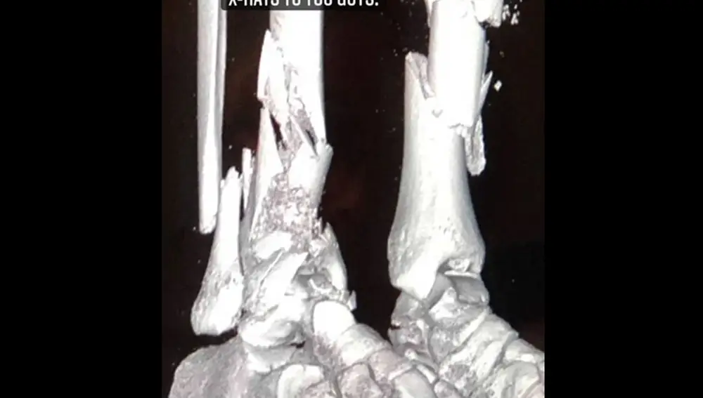 Imagen de rayos x de las múltiples fracturas que sufrió Juan Manuel Correa en sus piernas.