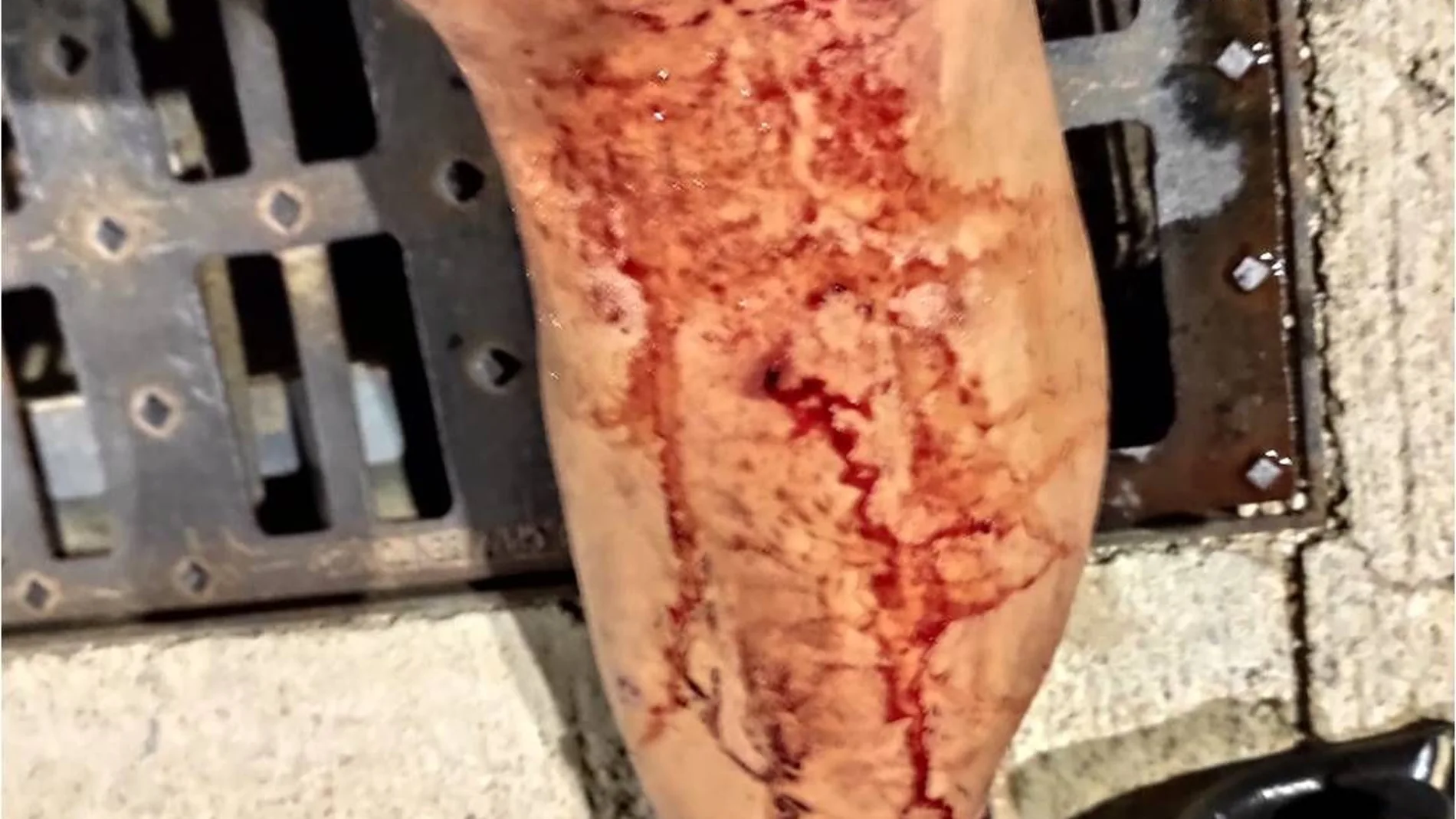Imagen de las lesiones sufridas por un agente en la pierna