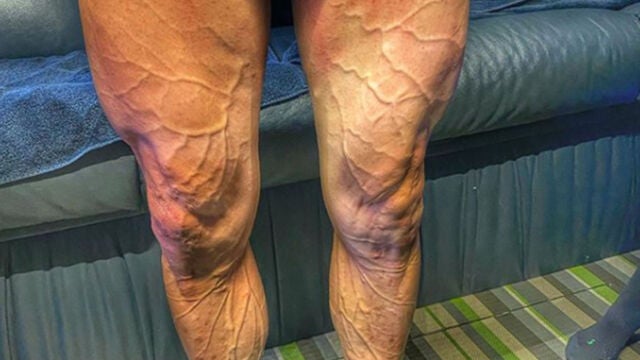 Así estaban las piernas de José Joaquín Rojas después de una etapa de LaVuelta.