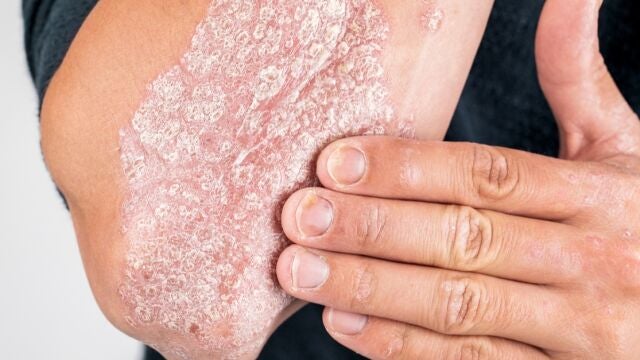 Psoriasis en brazoAEDV