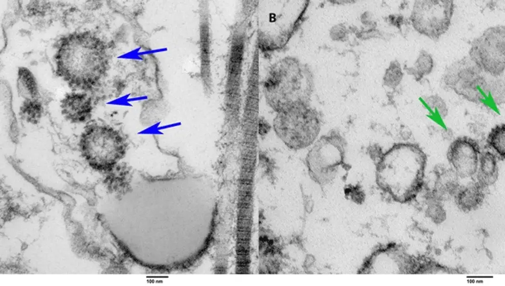 A la izquierda, el tejido de un paciente vivo previamente COVID positivo. A la derecha, el tejido recogido por autopsia de una persona que murió de COVID. Las flechas apuntan a las partículas virales de COVID en ambos especímenes.UNIVERSITY OF MIAMI MILLER SCHOO26/11/2020