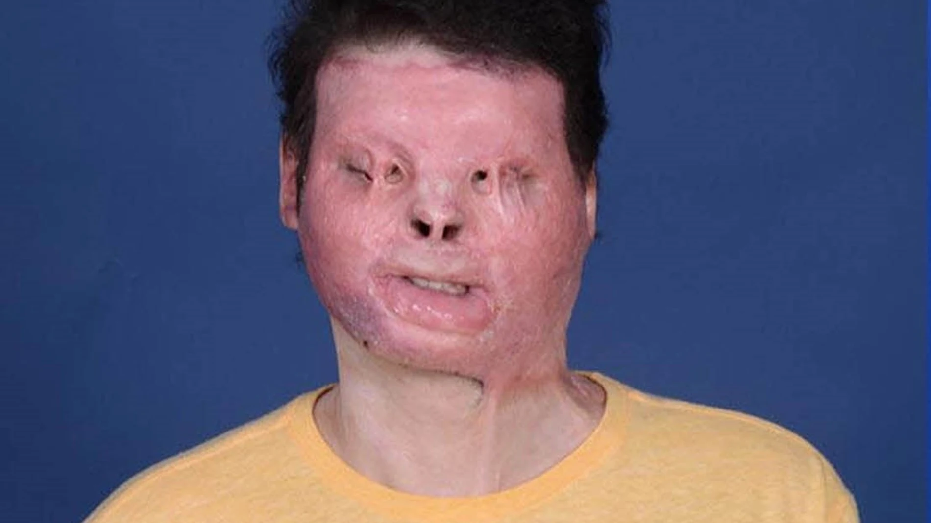 Antes y después del trasplante de cara y de las dos manos a Joe DiMeo