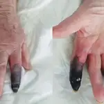 Los dedos de la anciana contagiada de covid