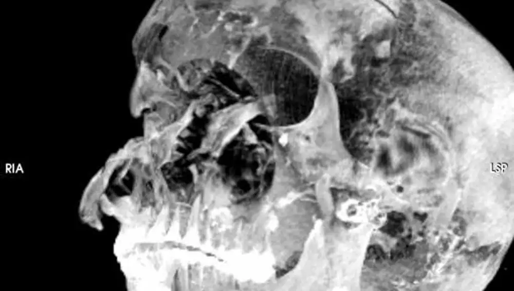 Radiografía del cráneo del faraón
