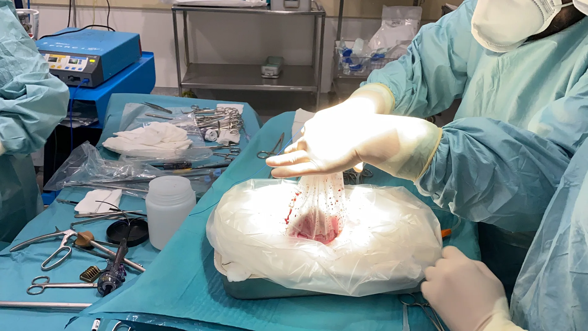 Las extracciones renales y los trasplantes se realizaron el mismo día en el Hospital Regional Universitario de Málaga y la Fondazione Policlinico Universitario Agostino Gemelli IRCSS de Roma