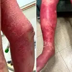 Erupción cutánea del paciente después de recibir la vacuna de Johnson