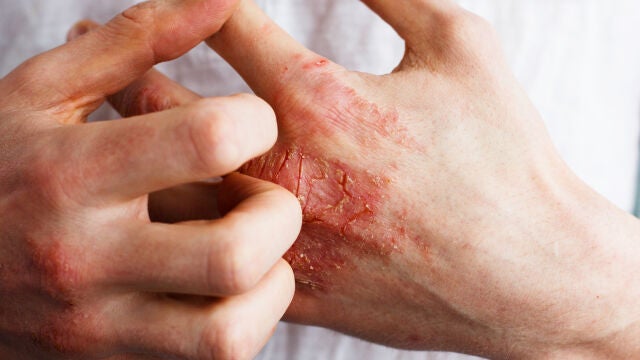 Psoriasis