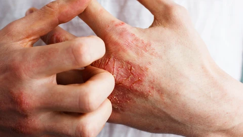 Psoriasis