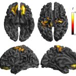 Alteración de la conectividad de la corteza orbitofrontal y somatosensorial, que se asocia a diferente (en sobrepeso) o anormal (en obesidad) actividad neuronal