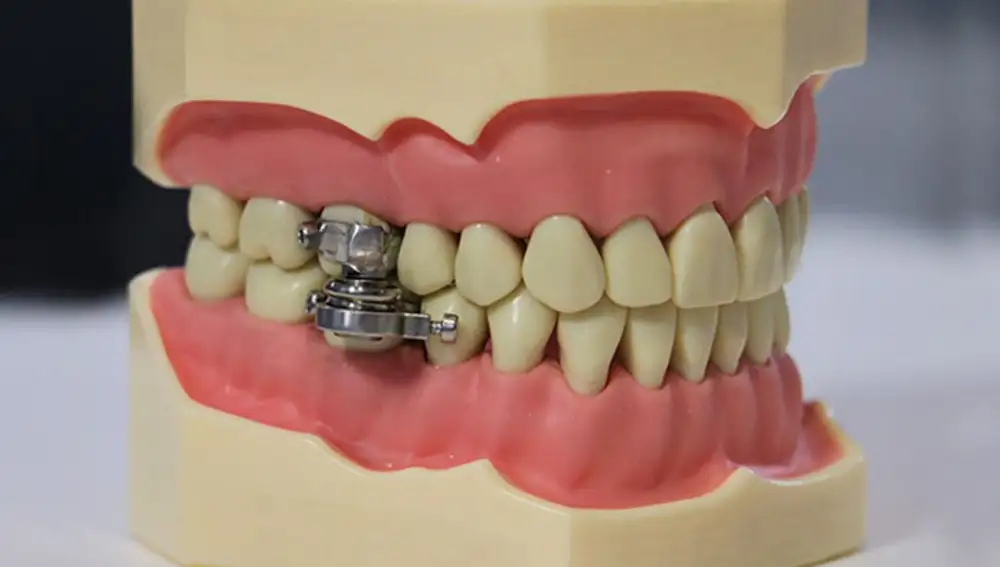 &quot;DentalSlim Diet Contro &quot;cierra los dientes con un &quot;candado&quot; para que los pacientes no puedan ingerir alimentos sólidos