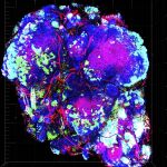 Tumor con zonas de hipoxia en color verde