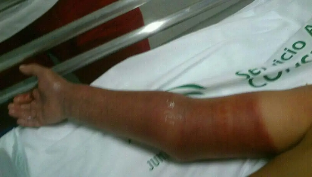 El brazo de la hija de Mercedes tras quedarse atrapado en el drenaje de la piscina