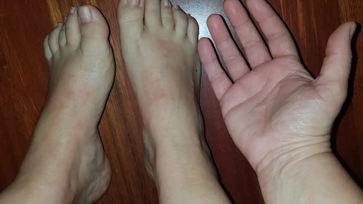 «No sé si podré dar el pecho a mi bebé por la urticaria por presión»