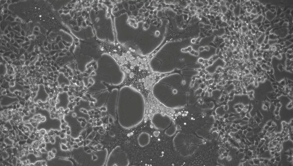 Célula infectada con una variante del Virus del Herpes Simplex generada durante el cultivo celular.