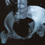 El cuerpo de un paciente con mieloma múltiple se llena de lesiones líticas, pequeños agujeritos en los huesos