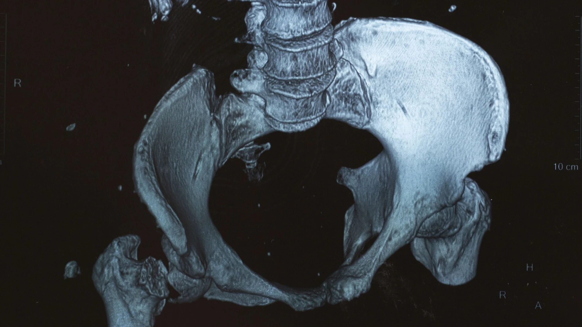 El cuerpo de un paciente con mieloma múltiple se llena de lesiones líticas, pequeños agujeritos en los huesos