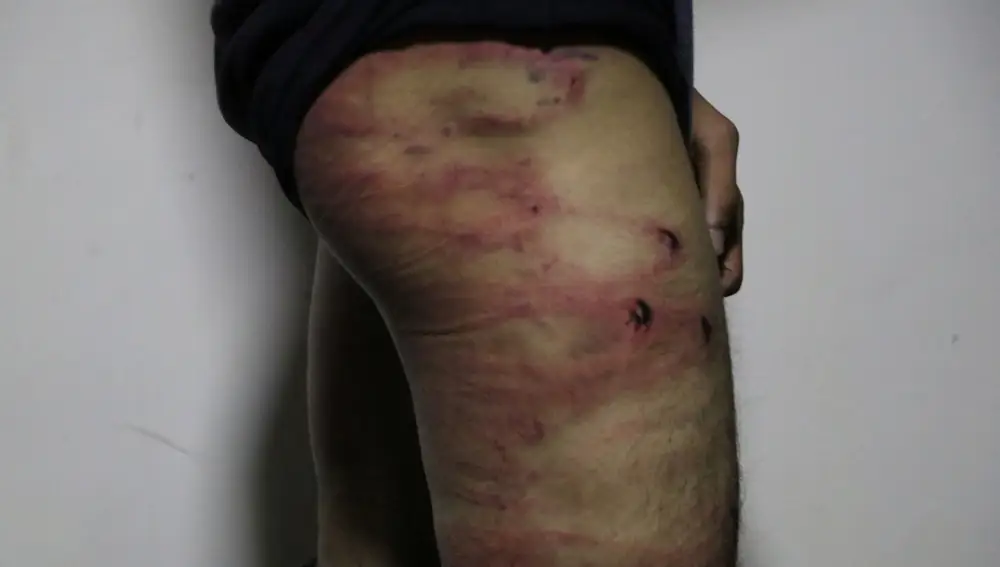 Un periodista muestra sus heridas después de la paliza que le propinaron los talibanes en Kabul, el 8 de septiembre