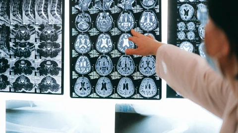 El ictus, primera causa de daño cerebral adquirido que afecta a población cada vez más joven