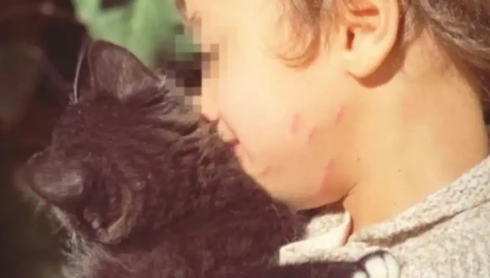 Cicatrices en el rostro del hijo de Raquel del Rosario, tras ser atacado por un puma