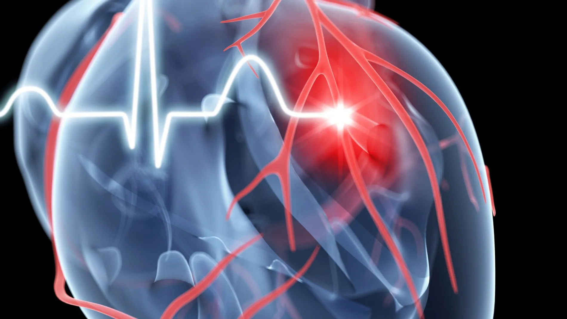 Descubren qué síntoma es peor en caso de infarto: ¿dificultad para respirar o dolor de pecho?